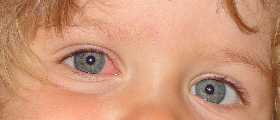 Слезится один глаз у ребенка от 1 года