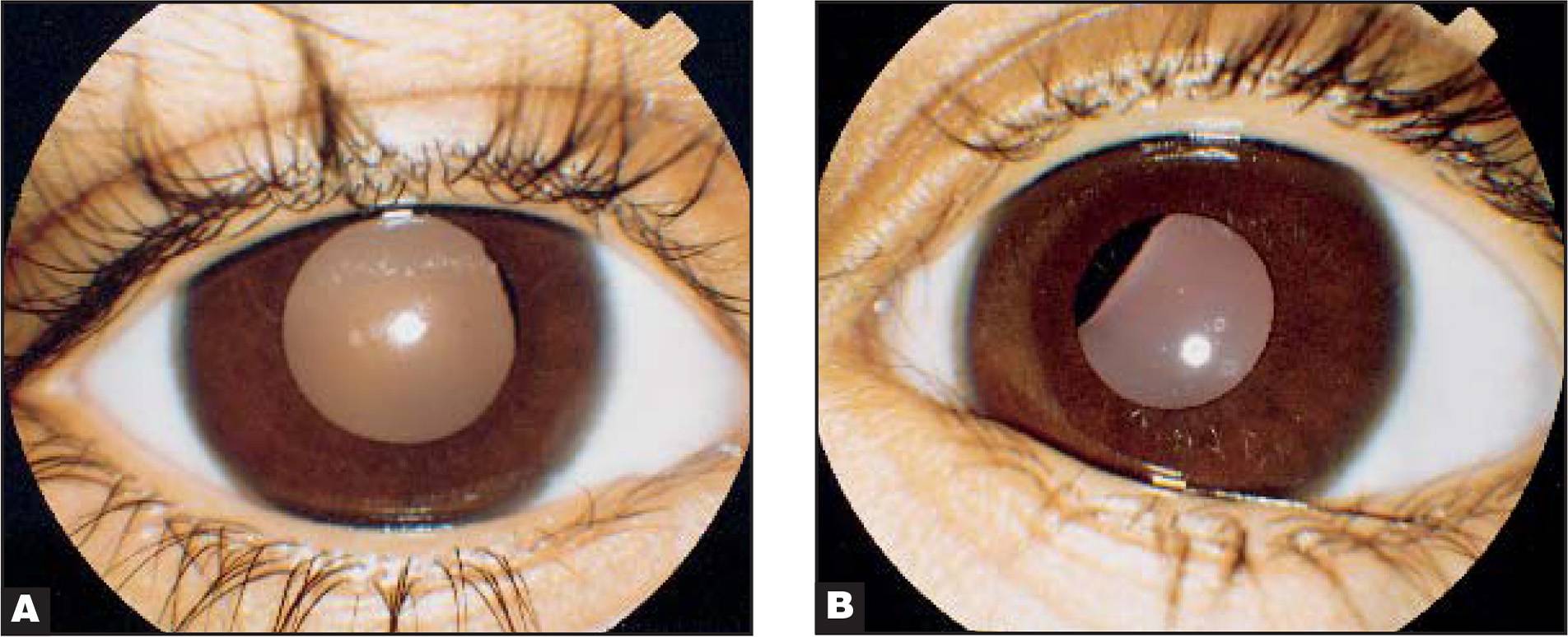 Анизокория глаза: причины, лечение, симптомы и диагностика