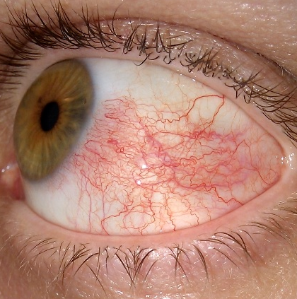Причины склерита глаза у детей и взрослых — виды склерита и симптомы заболевания