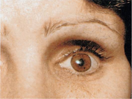 Заболевания глаз. часть 3. заболевания зрительного нерва, глазодвигательного аппарата, глазницы, глаукома
