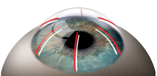Операция на глазах при близорукости: виды и проведение