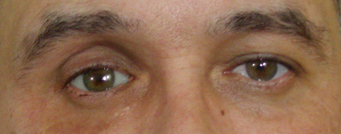 Стеклянные глаза у человека
