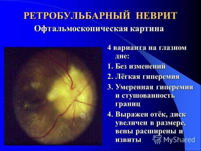 Неврит глазного нерва