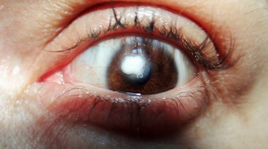 Бельмо на глазу у человека - фото, причины, симптомы и лечение