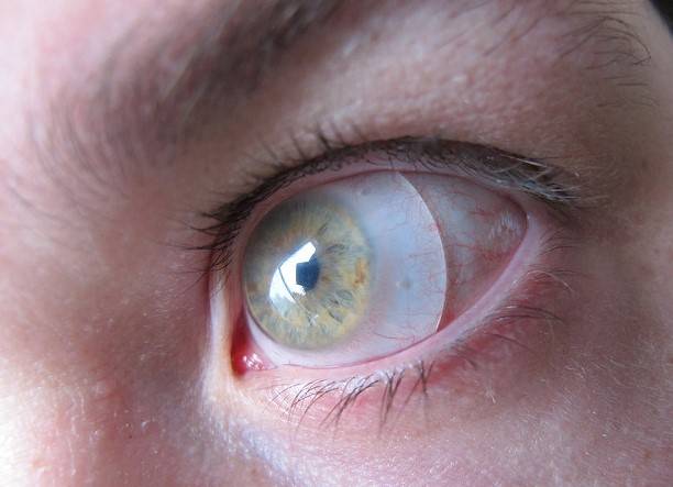 Все о контактных линзах: контактная коррекция зрения, показания и противопоказания. - сага-оптика