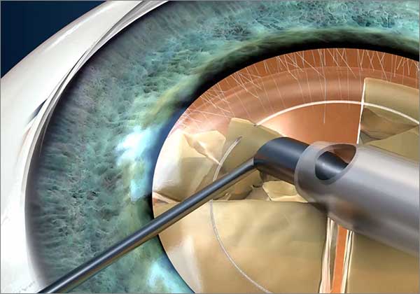 Факоэмульсификация катаракты - показания к операции, осложнения
