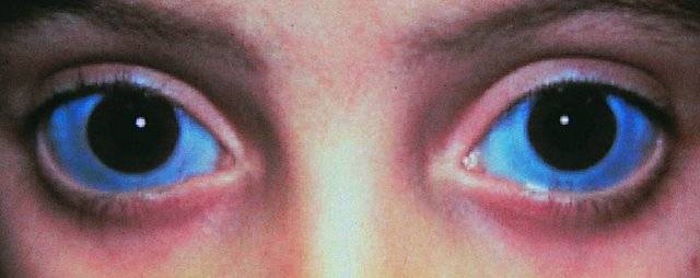 Голубые белки глаз - причины, что это означает