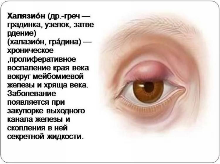 Как лечить внутренний ячмень (мейбомиит) на глазу: причины появления