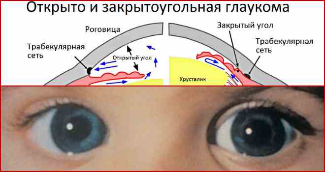 Закрытоугольная глаукома: причины, симптомы, лечение и профилактика