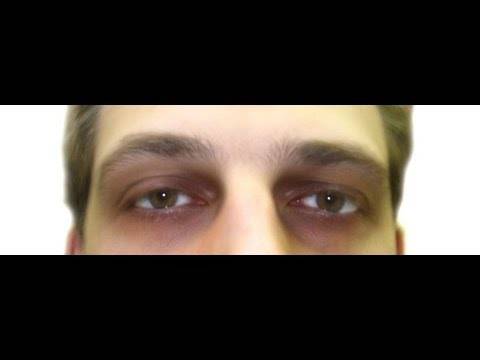 Причины возникновения тёмных кругов и синяков под глазами у мужчин и женщин, лечение