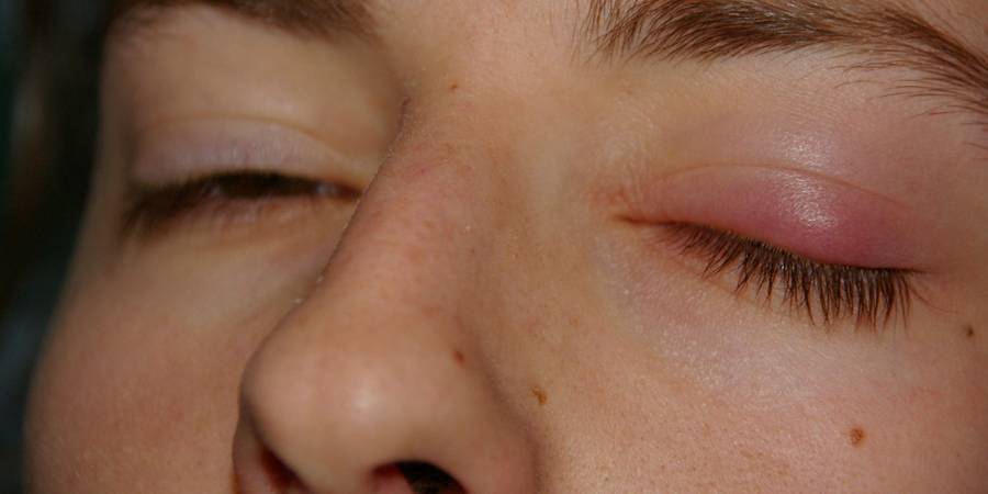 Причины опухания нижнего века глаза и способы лечения