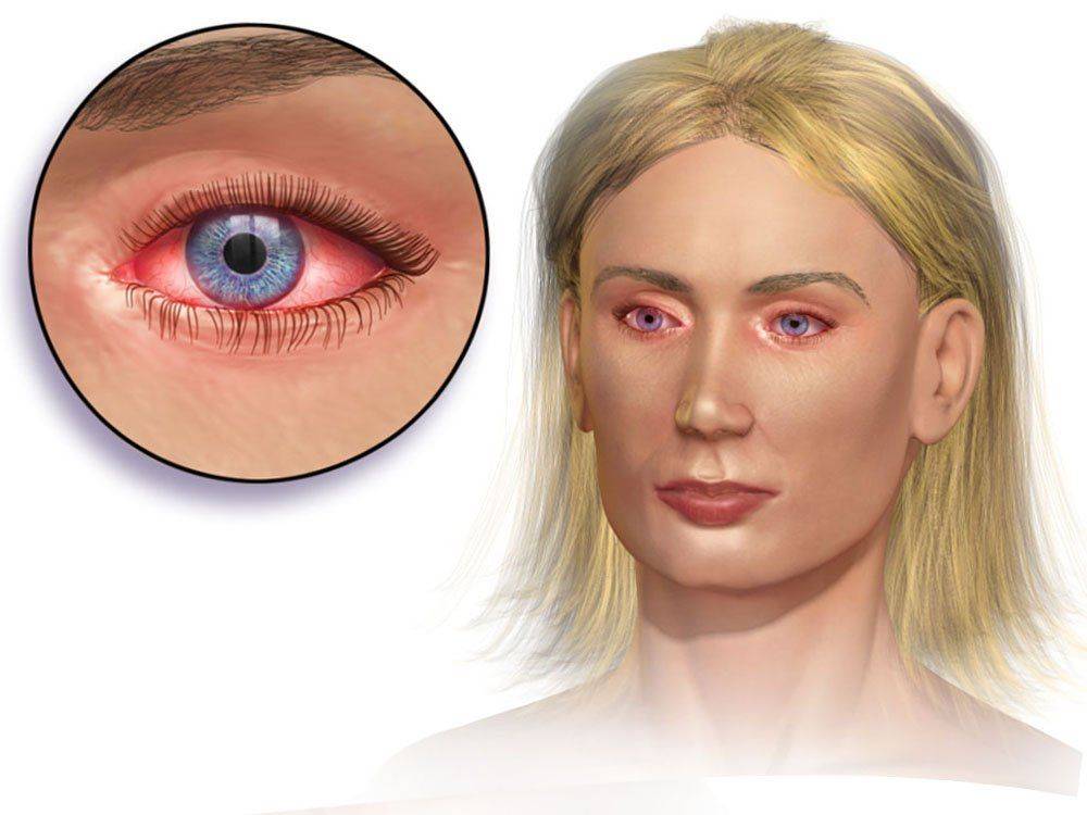 глаз при аллергическом конъюнктивите