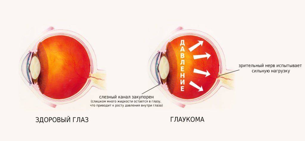 Схема глаза при глаукоме