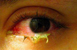 бактериальный конъюнктивит глаза