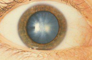 глаз при катаракте