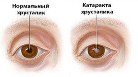 Здоровые глаза и при катаракте