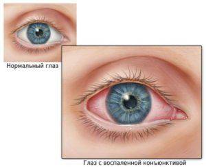 Воспаление глаза