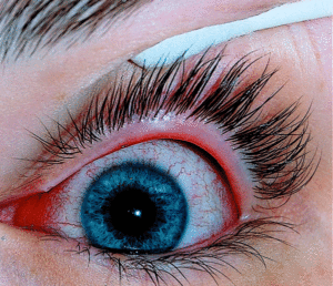 Гиперемия глаза: как выглядит