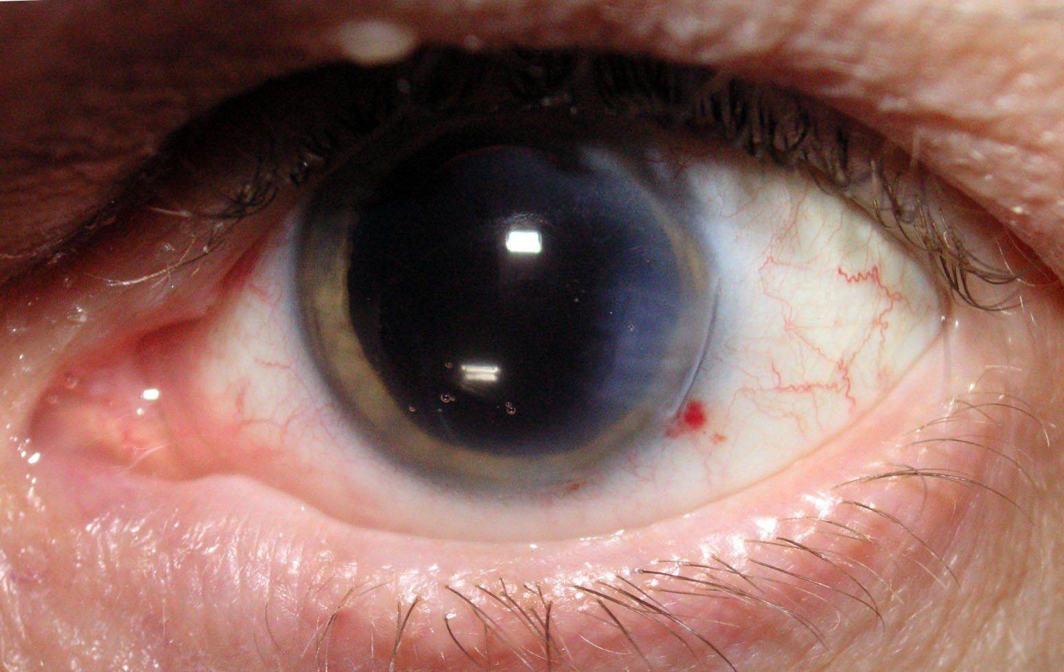 Вторичная катаракта