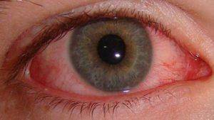 Электроофтальмия: как лечить лечить ожог глаз после воздействия ультрафиолетовых лучей