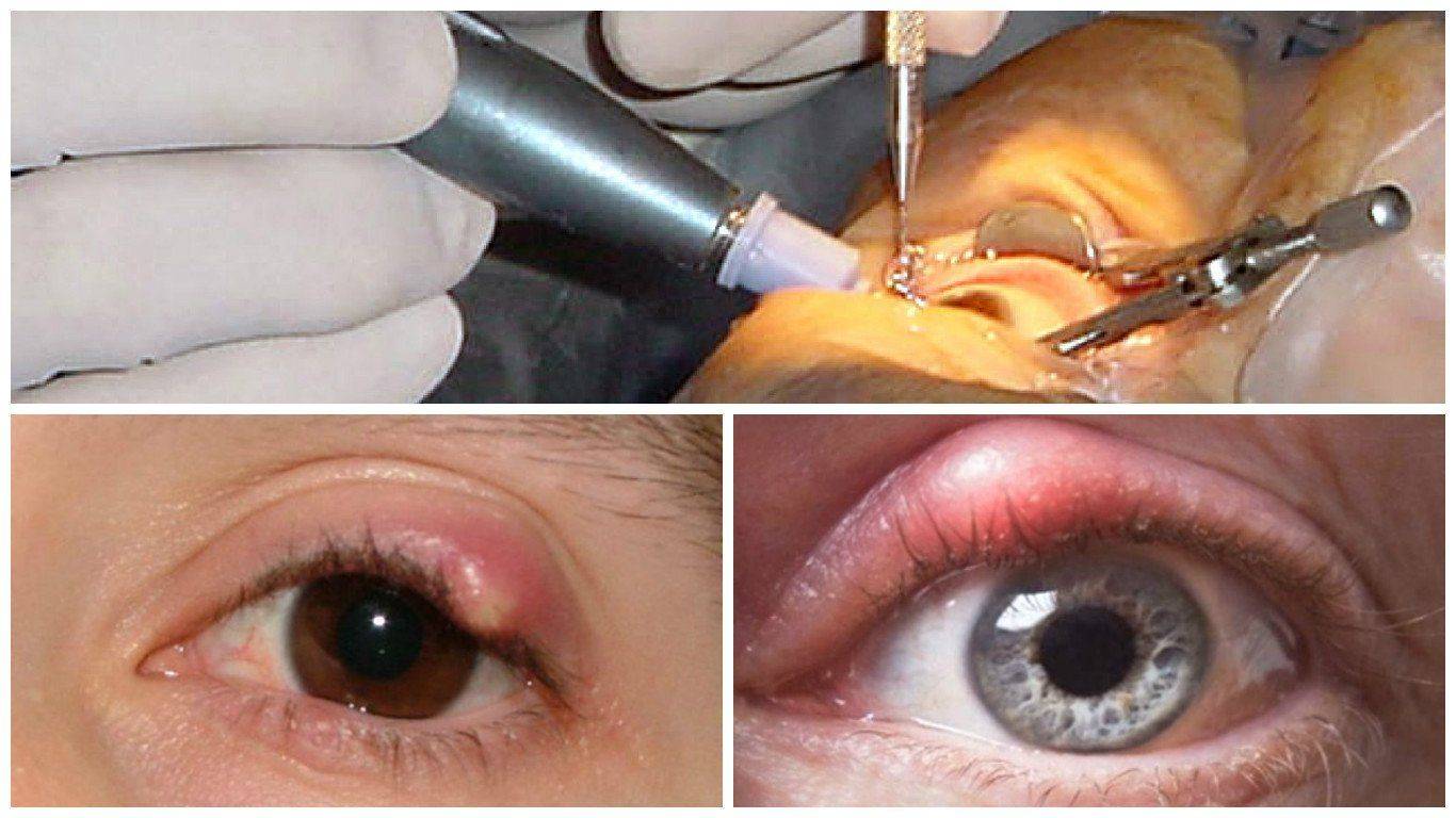 Халязионы на на глазу во время операции и до нее