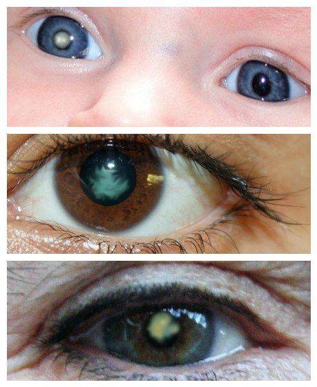 Что такое катаракта в любом возрасте