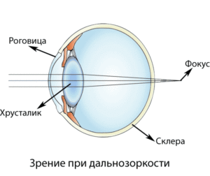 Как видит наш глаз при гиперметропии