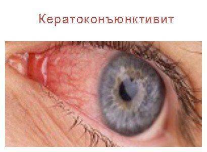 Кератоконъюктивит капли для глаз