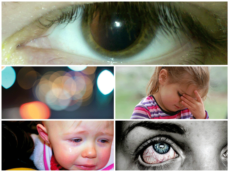 Ранняя стадия глаукомы симптомы
