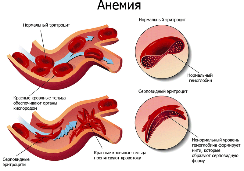 Что происходит при анемии