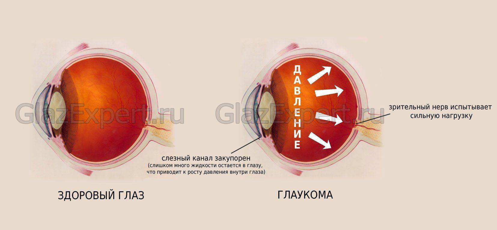 Процесс развития глаукомы