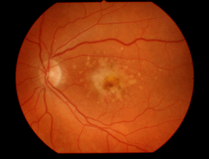 Как выглядит глазное дно при дистрофии сетчатки