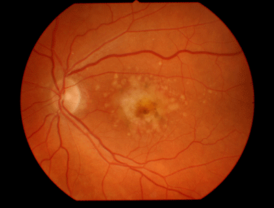 Как выглядит глазное дно при дистрофии сетчатки