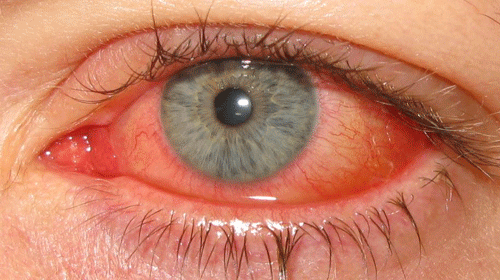 Глаз с конъюнктивитом