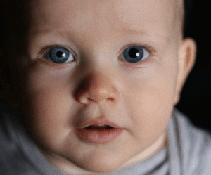 Зрачки разного размера (анизокория) у ребенка