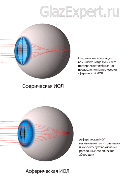 Разница между сферической и асферической ИОЛ