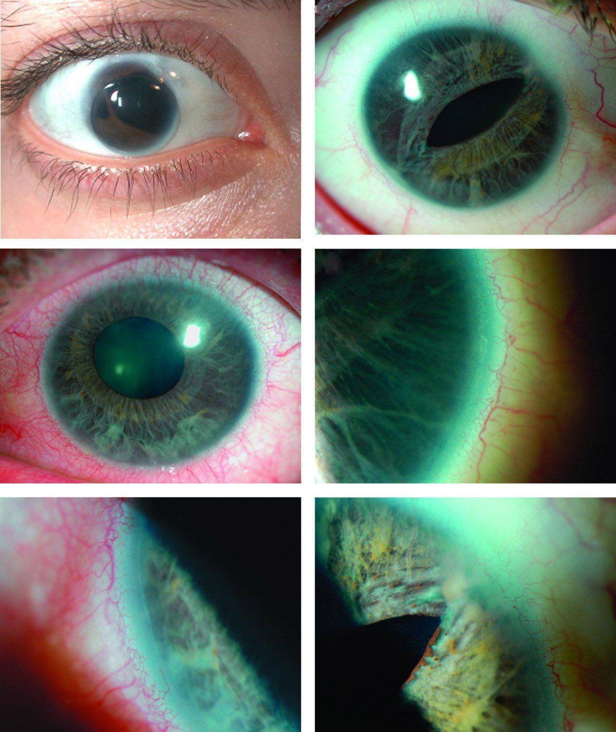 Состояние глаза при синдроме Аксенфельда