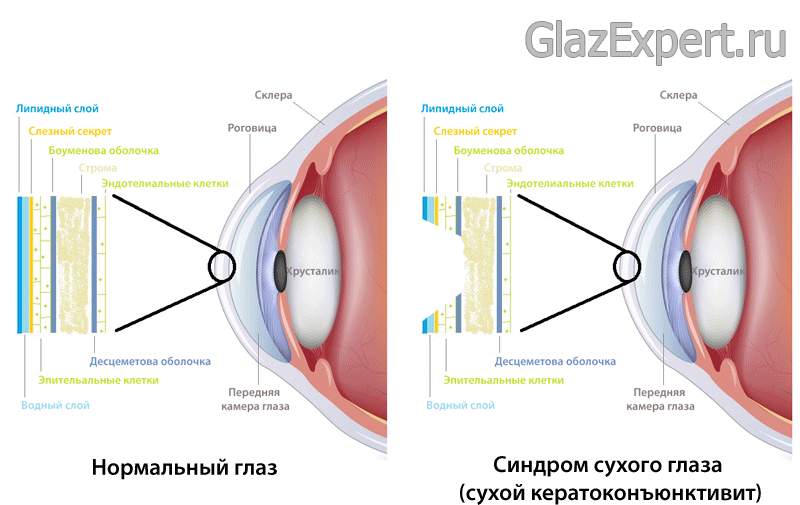 Что происходит при синдроме сухого глаза