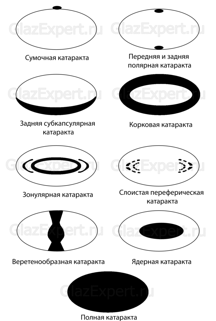 Виды и формы катаракты