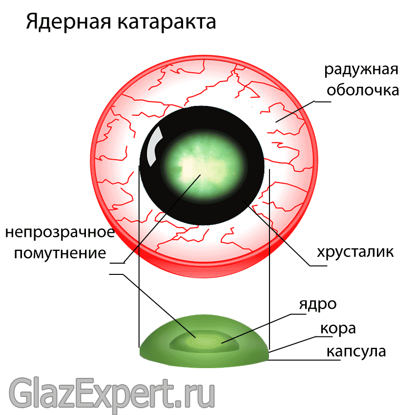Что такое ядерная катаракта