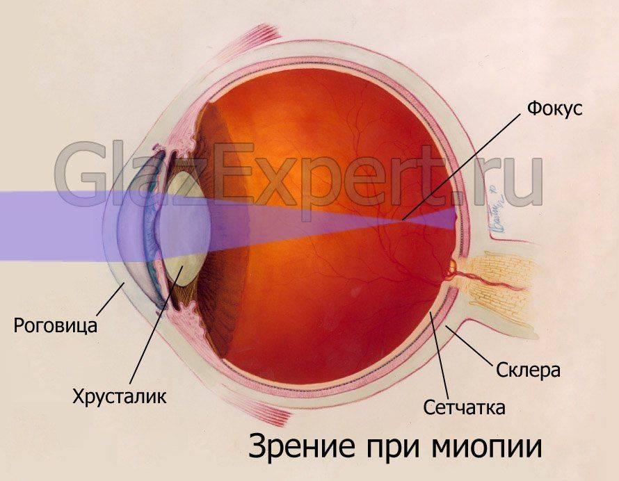 Глаз при миопии