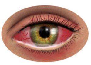 Как выглядит глаз при аллергии