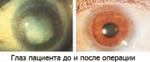 До и после операции при химическом ожоге глаза