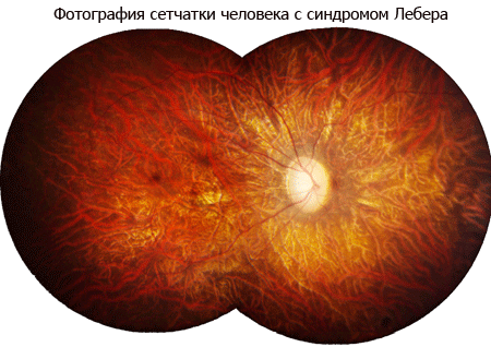 Нейропатия зрительных. Наследственная нейропатия зрительного нерва Лебера. Атрофия зрительного нерва Лебера.