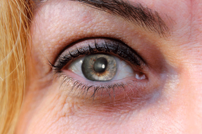 Глазная глаукома