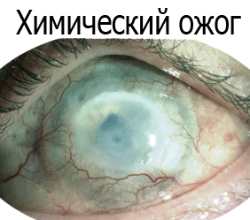 Как может выглядеть химический ожог глаз