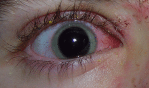 Механическая травма глаза