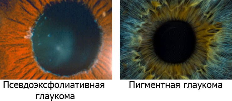 Псевдоэксфолиативная и пигментная глаукома