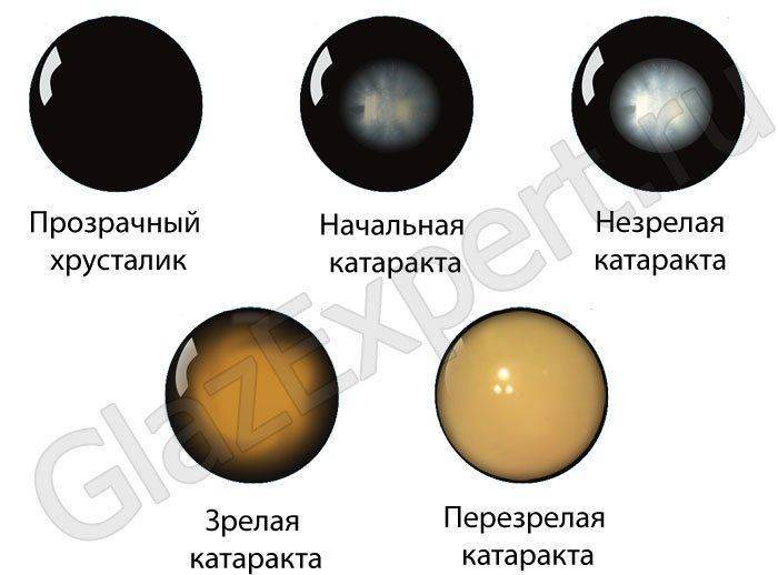 Основные стадии развития катаракты