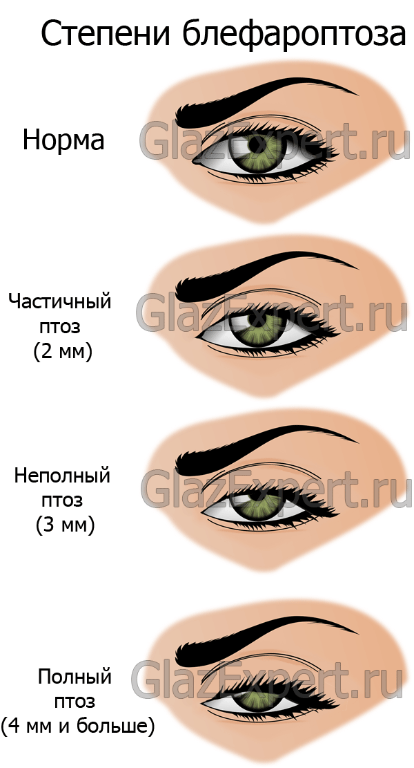 Болезни глаз: блефароптоз